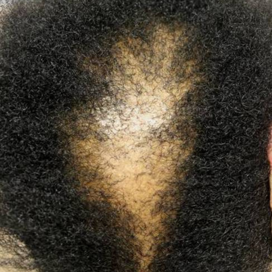 Afro-textured hair woman with CCCA