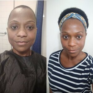 Living with Lupus and my healthy hair journey