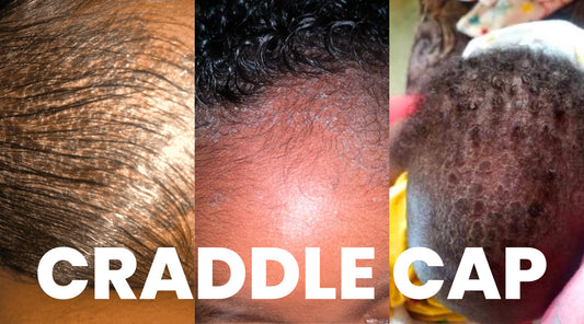 Cradle Cap in Black Babies: What Works, What Doesn't, and Why I Stopped Using Olive Oil